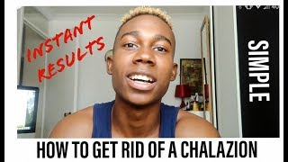 HOW TO GET RID OF A CHALAZION  instant results [upl. by Ailemak]