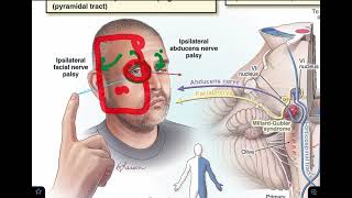 Millard Gubler syndrome  Ventral pontine syndrome  made super easy [upl. by Nylak822]