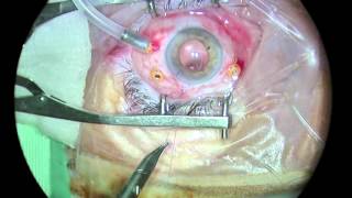 Vitrectomy Dropped Lens Nucleo Luxado  Vitrectomía [upl. by Rutherfurd746]