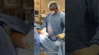 Lipedema Liposuction of Arm and Forearm  Dr Boris Volshteyn [upl. by Rawdan509]