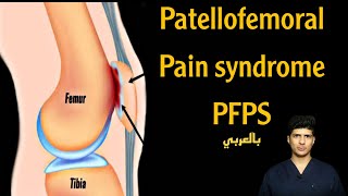 Patellofemoral pain syndrome PFPS course anterior knee pain [upl. by Larred]