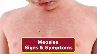 The 3 Warning Signs of Measles To Look Out For  How To Spot Measles Rash [upl. by Robbert]