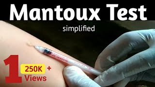 Mantoux Test to diagnosis TB infection  MT or TST or PPD Principle and Procedure [upl. by Jillayne]