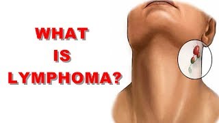 What is Lymphoma Cancer Of The Lymph System Non Hodgkins Lymph Node Cancer [upl. by Padriac]