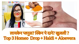 लायकेन प्लनुस के बारे में ज़रूरी जानकारी Oral Lichen Planus Homeopathic Medicine Lichen Homeopathy [upl. by Parry]