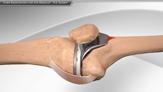 Knee Replacement with the iBalance TKA System [upl. by Jarietta]