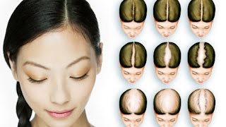 Hair Loss Treatment For Women Pattern Baldness Hair Falling Out Provillus For Women [upl. by Ahseei602]