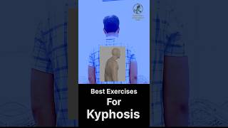 Struggling with Kyphosis Try These Exercises to Improve Posture [upl. by Onitram]