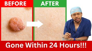 How to Rid Skin Tags and Warts Within 24 Hours  Dr Sanjay Sarkar on Skin Tag Removal [upl. by Aneleasor]