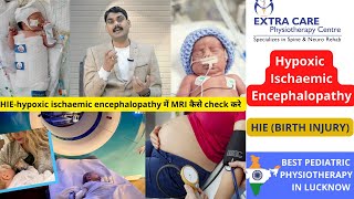 Hypoxic Ischaemic Encephalopathy  HIE in Babies Birth Injury  Pediatric Physiotherapy in Lucknow [upl. by Terra545]