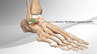 Chronic Ankle Sprain Repair With the InternalBrace™ Ligament Augmentation Procedure [upl. by Atkinson]