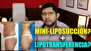 LIPOSUCCION TUMESCENTE  LIPOTRANSFERENCIA Aumento de Glúteo  facial  Antes y Después RESULTADOS [upl. by Ajnotal]