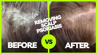 Removing Plaque Scalp Psoriasis  Using The AntiFungal Bundle myhappyscalpcom [upl. by Hidie]