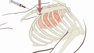 Pericardiocentese punção do pericárdio  New England Journal of Medicine legendadotraduzido [upl. by Arutak997]