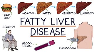 Understanding NonAlcoholic Fatty Liver Disease [upl. by Sylas]