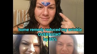 HOWTO overnight get rid of wrinkle between eyes [upl. by Anivlek]