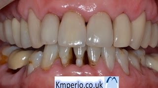 Treat Periodontal Gum Disease before Aesthetic Dentistry [upl. by Suirred]