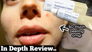 1 WEEK OF TRETINOIN 1 TEST CLEARING ACNE SCARS FAST The results [upl. by Krystal366]