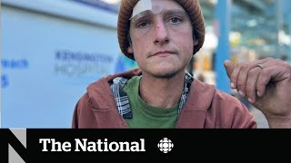 How a fleshrotting ‘zombie drug’ is complicating the overdose crisis [upl. by Delores]