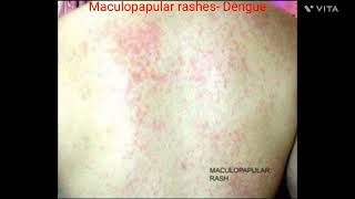 Maculopapular Rash in Dengue Rash in Dengue Fever petechial rash [upl. by Suoicerp81]