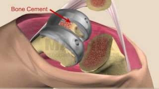 Total Knee Replacement [upl. by Suruat]