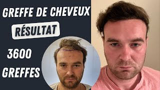 Résultat de la greffe de cheveux 3600 greffons l Avant et après l Greffe de cheveux en Turqui [upl. by Nedla]