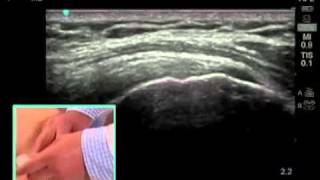 How To Ultrasound Guided Shoulder Injection Scanning Technique Video [upl. by Irbua]