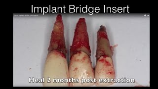 Dental Implant  Bridge Cementation [upl. by Cirtemed]