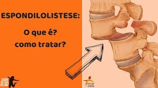 Espondilolistese O que é Como Tratar [upl. by Terrene]