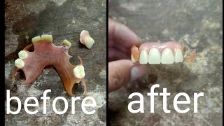 REPAIR FLEXIBLE DENTURE [upl. by Helsa]