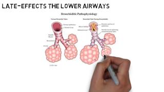 bronchiolitisdefinitioncausespathologysymptomsdiagnosistreatment [upl. by Mumford]