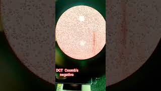 🔬DCT coombs negative test slide🧪 [upl. by Eelyk863]