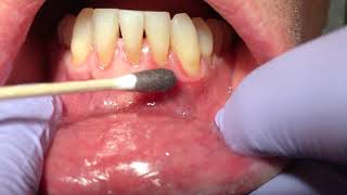 Dr Laurence Rifkin Treatment of Mouth Ulcer [upl. by Digdirb]