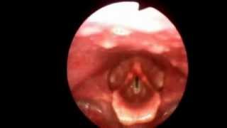 Flexible Video Stroboscopy Exam Kansas Voice Center [upl. by Aillicsirp627]