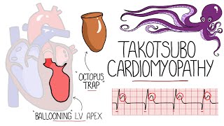 Takotsubo Cardiomyopathy Explained Broken Heart Syndrome [upl. by Htebi]