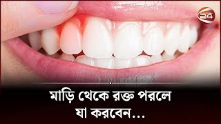 মাড়ি ফুলে যাচ্ছে বা মাড়ি থেকে রক্ত পরছে কি করবেন  Oral Gum Infection  Oral Health  Channel 24 [upl. by Reppiks]