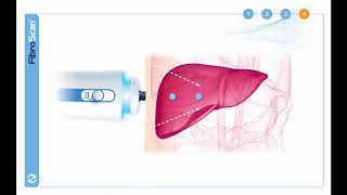 ¿Cómo funciona el FibroScan [upl. by Jermayne]