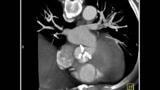 4D Imaging of the Aortic Valve Aortic valve 3 of 3 [upl. by Samala]