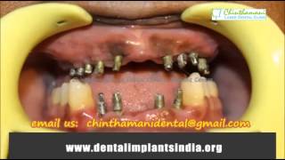 Teeth Restoration Chennai  Full Mouth Reconstruction India [upl. by Radu280]