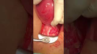 ureteric disection during abdominal hysterectomy dr ibrahim Saif El Naser [upl. by Ise985]