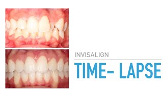 Invisalign TimeLapse TheOrthodonticCentre [upl. by Eendys117]