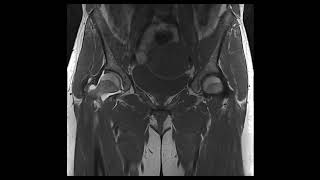 Hip Labral Tear [upl. by Nnyletak]