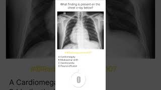 Chest Xray Buzz 21 radiologychannel007 [upl. by Naniac938]