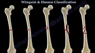 Fractures Of The Femur Shaft Winquist amp Hansen  Everything You Need To Know  Dr Nabil Ebraheim [upl. by Arehahs903]