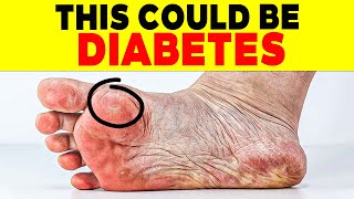 ALERT 18 SIGNS of DIABETES on THE SKIN that FEW PEOPLE KNOW  110 [upl. by Adnoel]