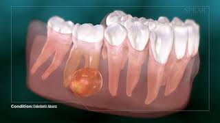 Dental Abcess  Why Root Canal Treatment Is Needed [upl. by Llennaj]