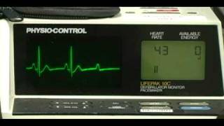 2nd Degree Type II Heart Block [upl. by Deadman]