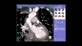 Cardiac CT Case Review Webinar 111511 [upl. by Pellikka706]