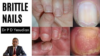 Brittle nails  causes and treatment [upl. by Ardnait151]