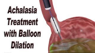 Sinus Balloon Catheter Maxillary Dilation An Inside Look [upl. by Odidnac]